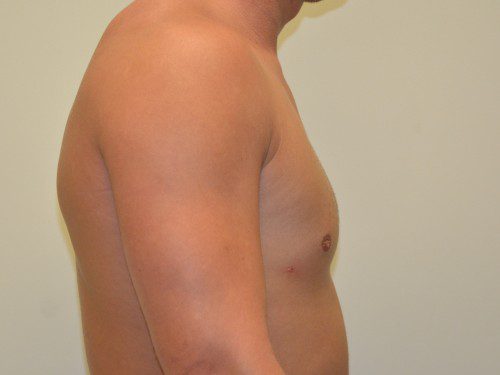 Male Breast Reduction After Patient 5