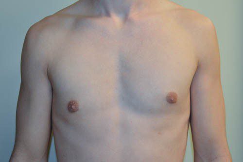 Male Breast Reduction After Patient 1