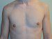 Male Breast Reduction After Patient Thumbnail 1