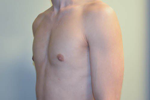 Male Breast Reduction After Patient 2