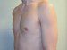 Male Breast Reduction After Patient Thumbnail 2