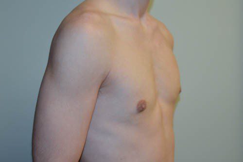 Male Breast Reduction After Patient 4