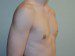 Male Breast Reduction After Patient Thumbnail 4