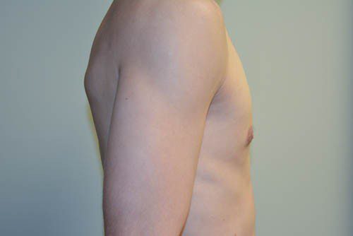 Male Breast Reduction After Patient 5