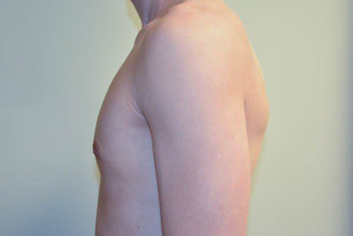 Male Breast Reduction After Patient 3