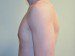 Male Breast Reduction After Patient Thumbnail 3