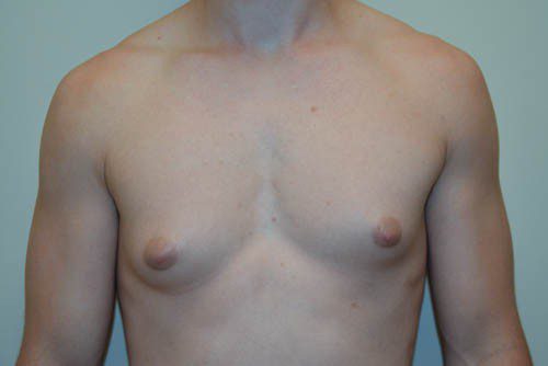 Male Breast Reduction Before Patient 1