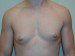 Male Breast Reduction Before Patient Thumbnail 1