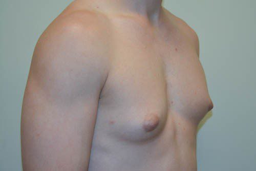 Male Breast Reduction Before Patient 4