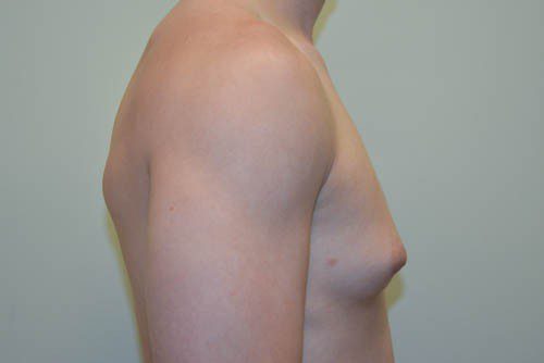 Male Breast Reduction Before Patient 5