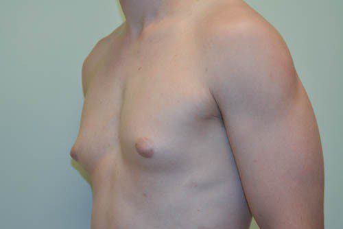 Male Breast Reduction Before Patient 2