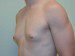 Male Breast Reduction Before Patient Thumbnail 2