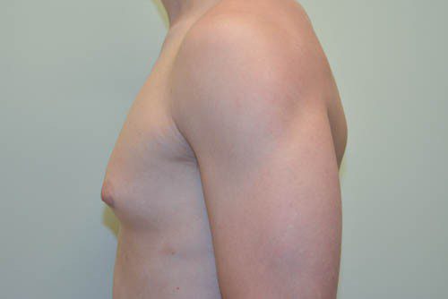 Male Breast Reduction Before Patient 3