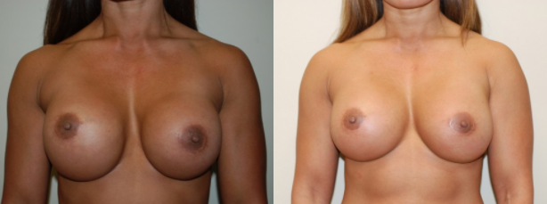 Breast Revision Before and After Photos