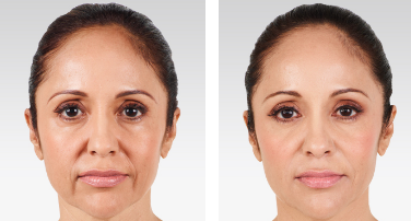 Before and After JUVEDERM