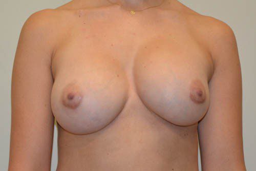 Breast Implant Removal Before Patient 1