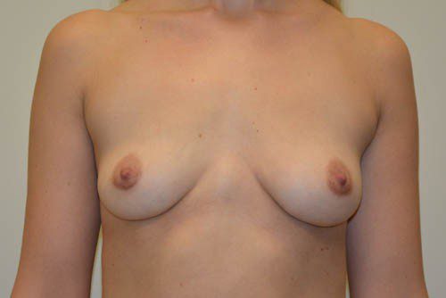 Breast Implant Removal After Patient 1