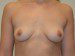 Breast Implant Removal After Patient Thumbnail 1