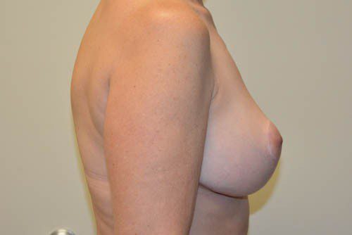 Breast Reduction After Patient 3