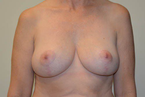 Breast Reduction After Patient 1