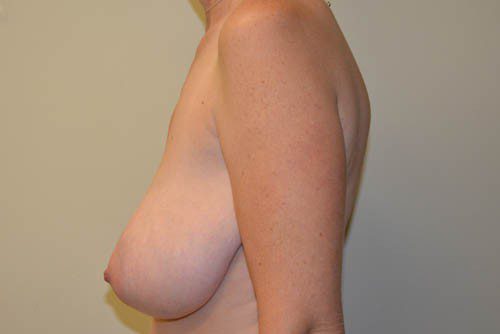 Breast Reduction Before Patient 5