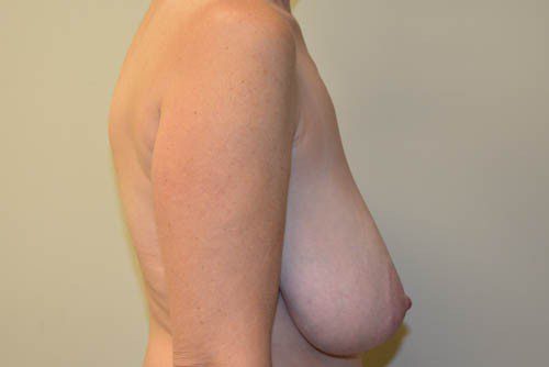 Breast Reduction Before Patient 3