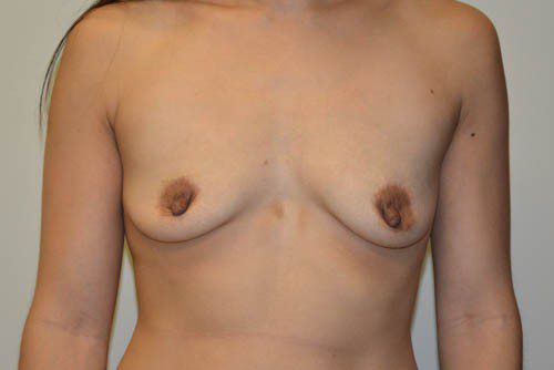 Breast Augmentation Before Patient 1