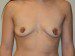 Breast Augmentation Before Patient Thumbnail 1