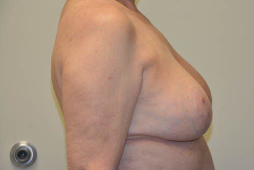 Breast Reduction After Patient 3