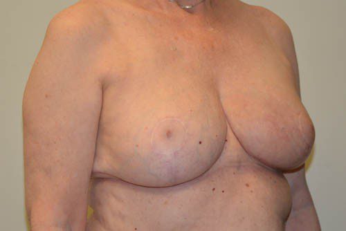 Breast Reduction After Patient 2