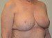 Breast Reduction After Patient Thumbnail 2