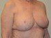 Breast Reduction After Patient Thumbnail 2