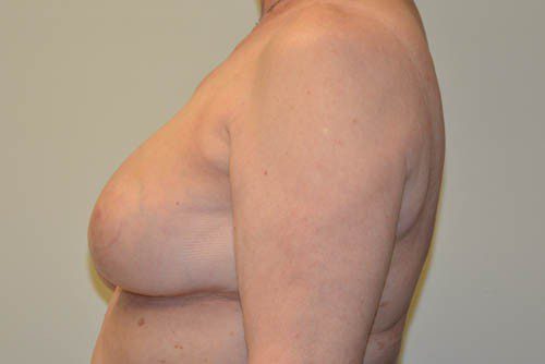 Breast Reduction After Patient 5