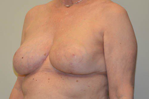 Breast Reduction After Patient 4