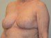 Breast Reduction After Patient Thumbnail 4