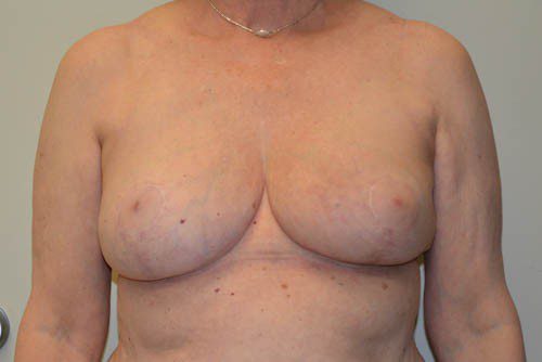 Breast Reduction After Patient 1