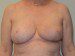 Breast Reduction After Patient Thumbnail 1