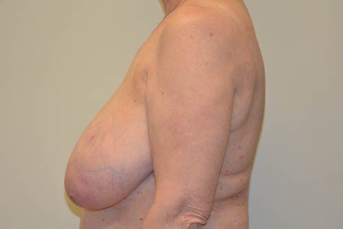 Breast Reduction Before Patient 5