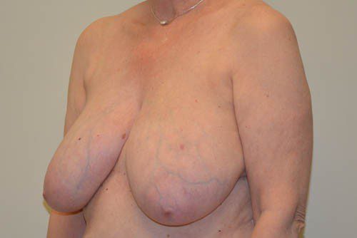 Breast Reduction Before Patient 4