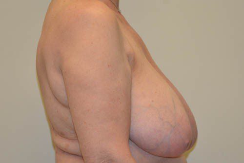 Breast Reduction Before Patient 3