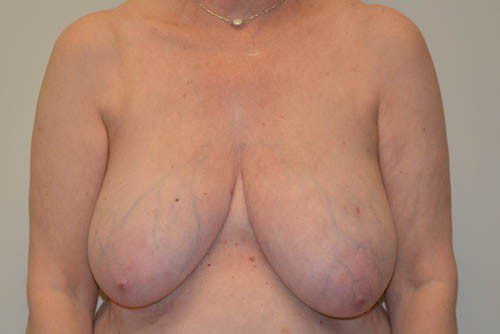 Breast Reduction Before Patient 1