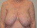 Breast Reduction Before Patient Thumbnail 1