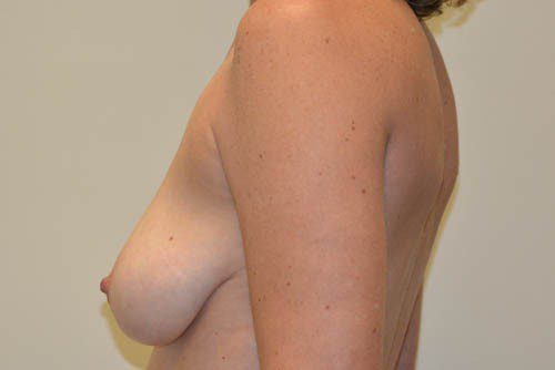 Breast Lift Before Patient 3