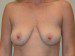 Breast Lift Before Patient Thumbnail 1