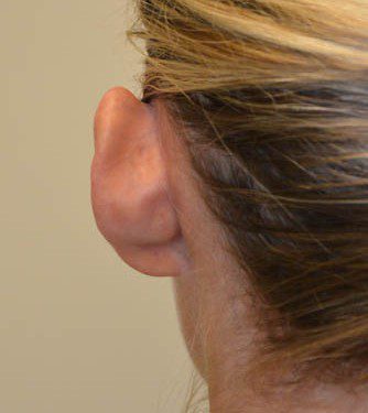 Prominent Ear Surgery Before Patient 1