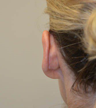 Prominent Ear Surgery After Patient 1