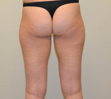 Liposuction Before Patient 2