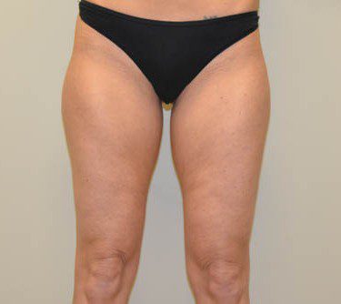 Liposuction Before Patient 1