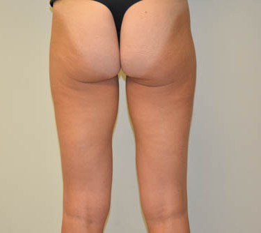 Liposuction After Patient 2