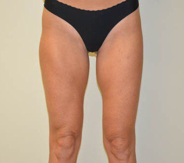 Liposuction After Patient 1